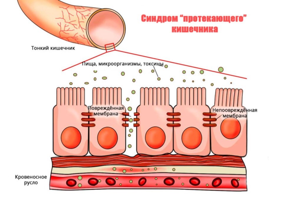 Стенки кишечника состоят из энтероцитов, соединенных между собой мембранами. При СРК мембраны повреждаются и образуются бреши, через которые в кровь проникают чужеродные белки и токсины.